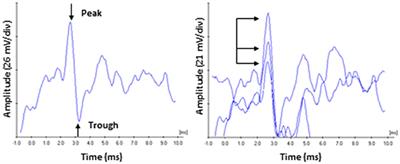 Outer Hair Cell and Auditory Nerve Function in Speech Recognition in Quiet and in Background Noise